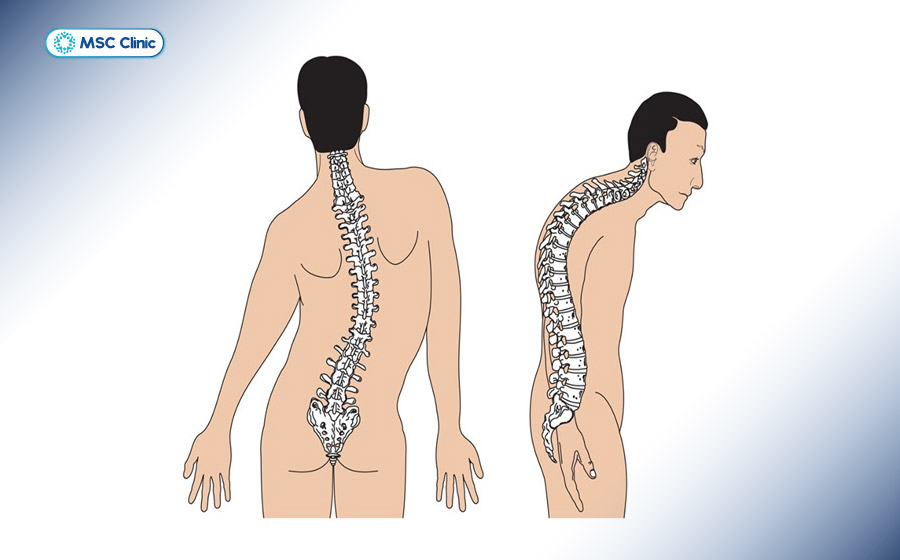 Người bị cong vẹo cột sống có khả năng bị thoái hóa đốt sống ngực cao hơn