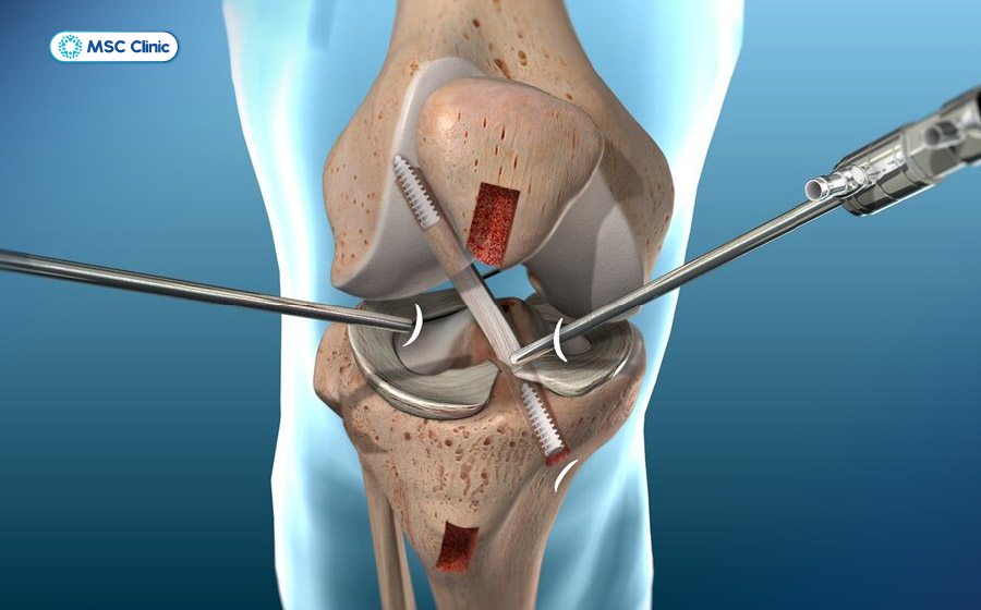 Phẫu thuật điều trị rách dây chằng cần được cân nhắc kỹ lưỡng từ bác sĩ chuyên khoa