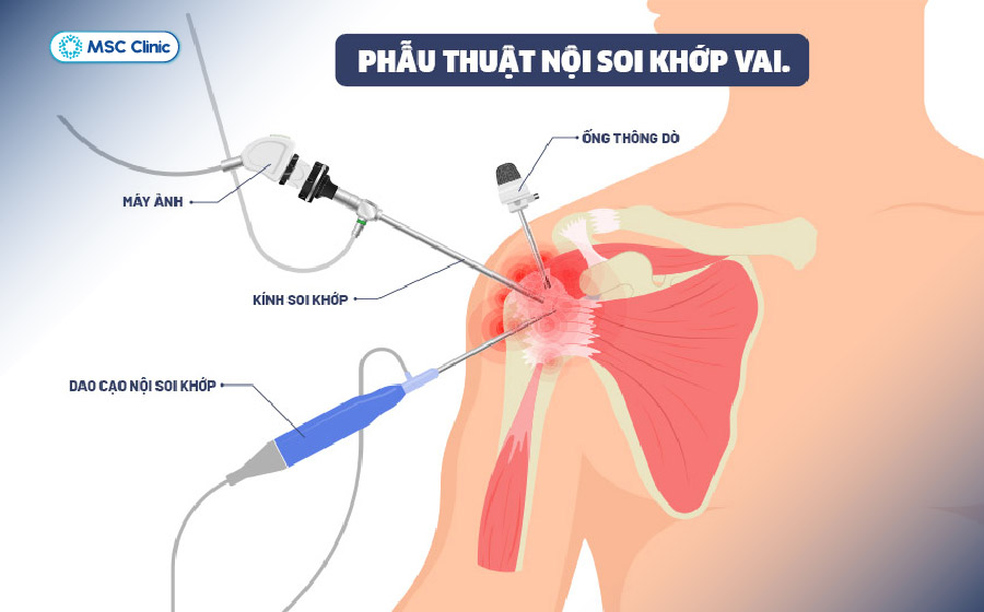 Phẫu thuật được cân nhắc khi vai tiếp tục mất vững sau điều trị bảo tồn hoặc có tổn thương sụn viền, bao khớp và xương làm tăng nguy cơ tái trật Phẫu thuật được cân nhắc khi vai tiếp tục mất vững sau điều trị bảo tồn hoặc có tổn thương sụn viền, bao khớp và xương làm tăng nguy cơ tái trật
