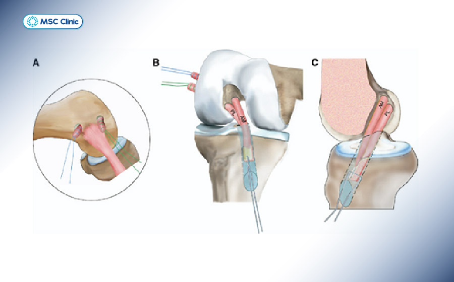 Phẫu thuật tái tạo dây chằng có thể được cân nhắc khi khớp mất vững rõ và chức năng không cải thiện với điều trị bảo tồn Phẫu thuật tái tạo dây chằng có thể được cân nhắc khi khớp mất vững rõ và chức năng không cải thiện với điều trị bảo tồn