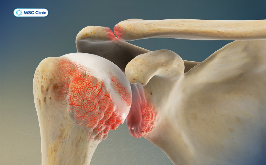 Rách sụn viền khớp vai không được điều trị có thể dẫn đến thoái hóa khớp vai