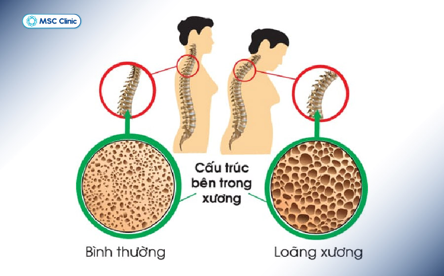 So sánh cấu trúc của xương bình thường và loãng xương So sánh cấu trúc của xương bình thường và loãng xương