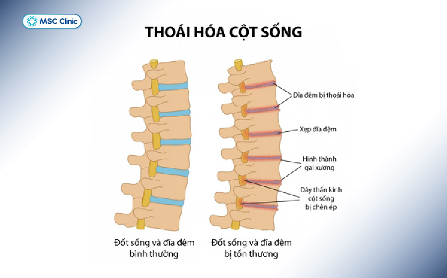 Thoái hóa cột sống có thể làm đĩa đệm giảm chiều cao, khớp liên đốt sống bị hao mòn và hình thành gai xương Thoái hóa cột sống có thể làm đĩa đệm giảm chiều cao, khớp liên đốt sống bị hao mòn và hình thành gai xương