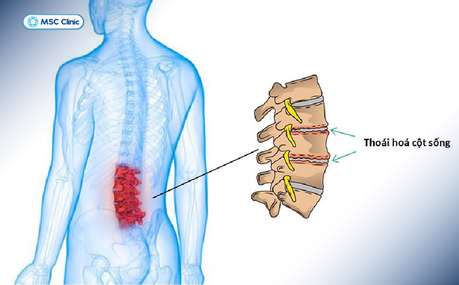 Thoái hóa cột sống vùng thắt lưng có thể là nguyên nhân khiến đau lưng khi ngủ dậy kéo dài và tái phát