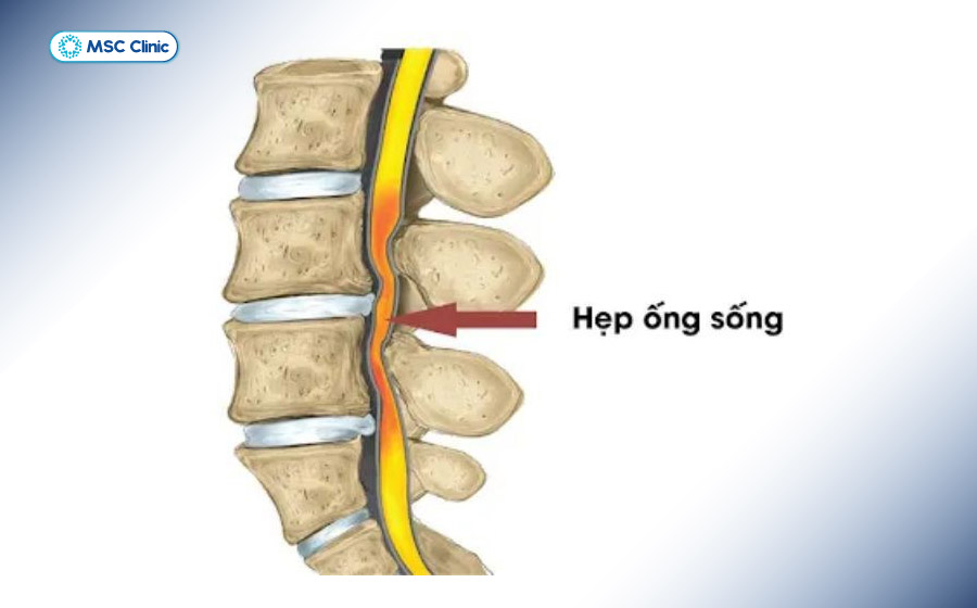 Thoái hóa đốt sống ngực có thể gây hẹp ống sống nếu không được điều trị kịp thời