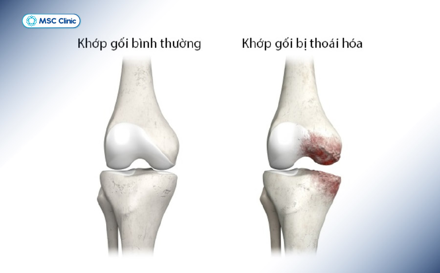 Thoái hóa khớp tiến triển có thể làm thay đổi cấu trúc và trục chịu lực, khiến người bệnh cảm thấy lỏng khớp gối.
