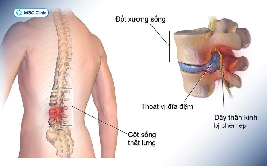 Thoát vị đĩa đệm chèn ép rễ thần kinh, gây đau lan từ cổ hoặc lưng xuống tay chân, kèm tê bì Thoát vị đĩa đệm chèn ép rễ thần kinh, gây đau lan từ cổ hoặc lưng xuống tay chân, kèm tê bì
