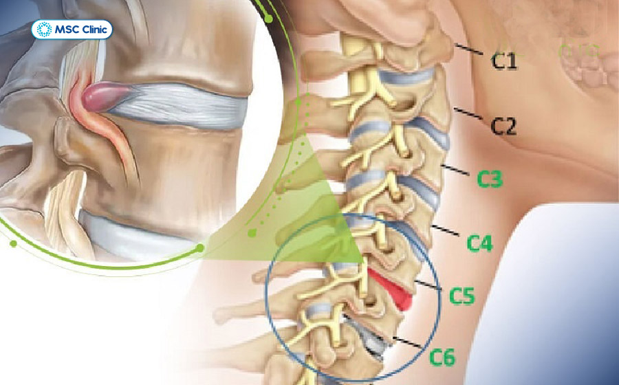 Thoát vị đĩa đệm cột sống cổ là một trong những nguyên nhân phổ biến gây chèn ép rễ thần kinh cổ