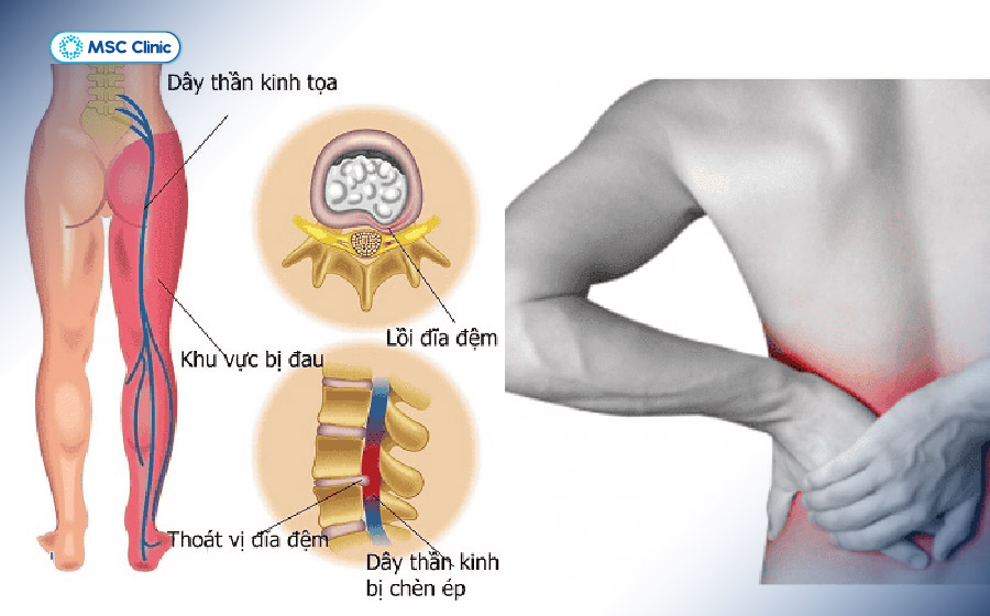 Thoát vị đĩa đệm vùng thắt lưng gây cơn đau nhức xuống chân