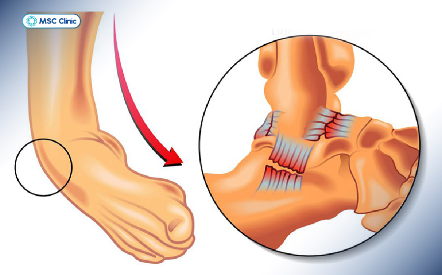 Thời gian hồi phục tình trạng rách dây chằng ở cổ chân kéo dài vài tháng hoặc hơn