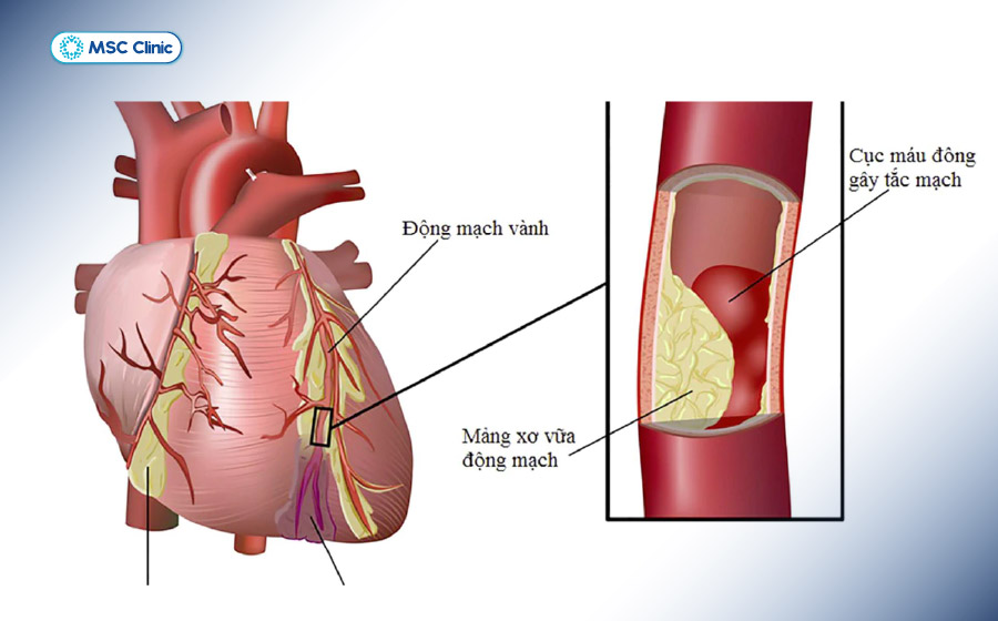 Tiểu đường không được điều trị gây nguy cơ xơ vữa động mạch