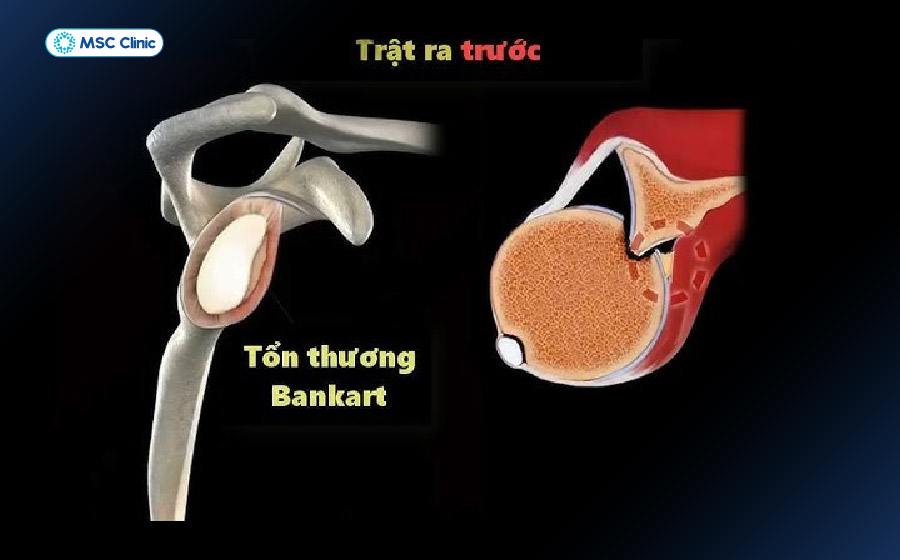 Tổn thương Bankart là tình trạng sụn viền trước - dưới bị bong khỏi bờ ổ chảo Tổn thương Bankart là tình trạng sụn viền trước - dưới bị bong khỏi bờ ổ chảo