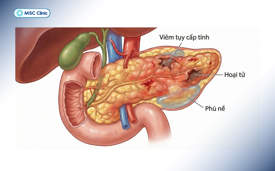 Tổn thương tuyến tụy làm suy giảm khả năng sản xuất insulin của cơ thể
