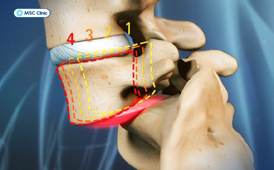 Trượt đốt sống xảy ra khi một đốt sống dịch chuyển khỏi vị trí bình thường so với đốt sống liền kề Trượt đốt sống xảy ra khi một đốt sống dịch chuyển khỏi vị trí bình thường so với đốt sống liền kề