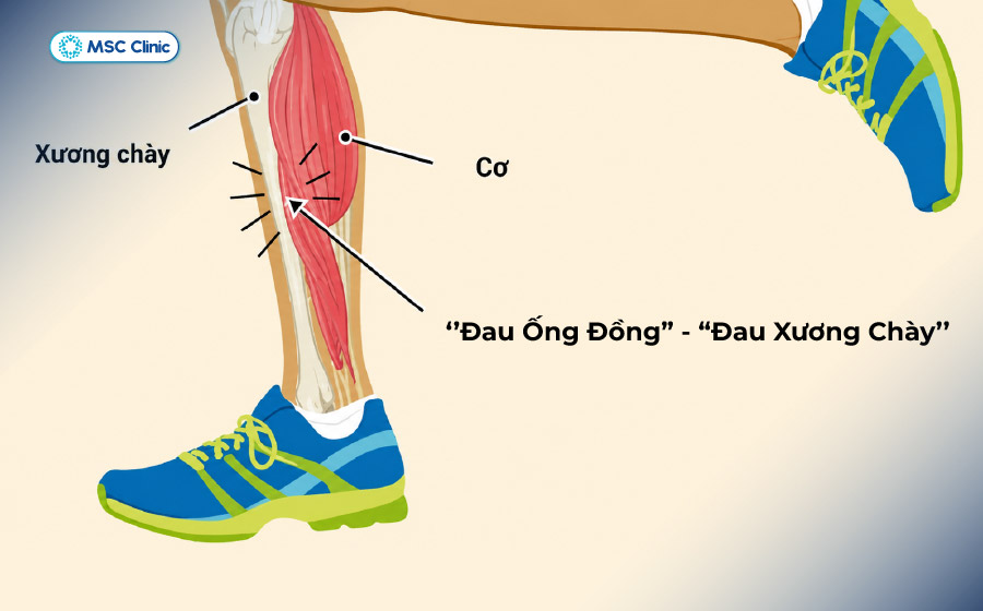 Vận động chân quá tải khi chơi thể thao có thể gây đau buốt xương ống chân