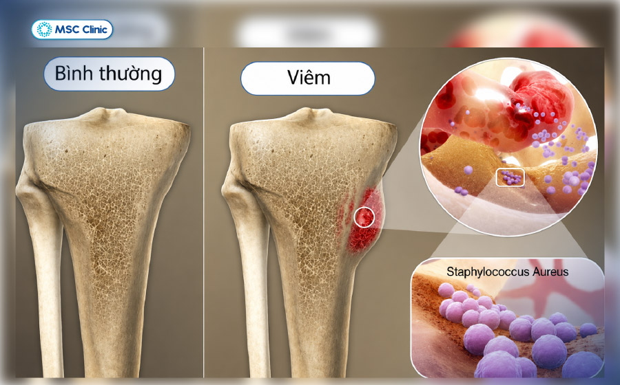 Vi khuẩn Staphylococcus aureus gây viêm tủy xương