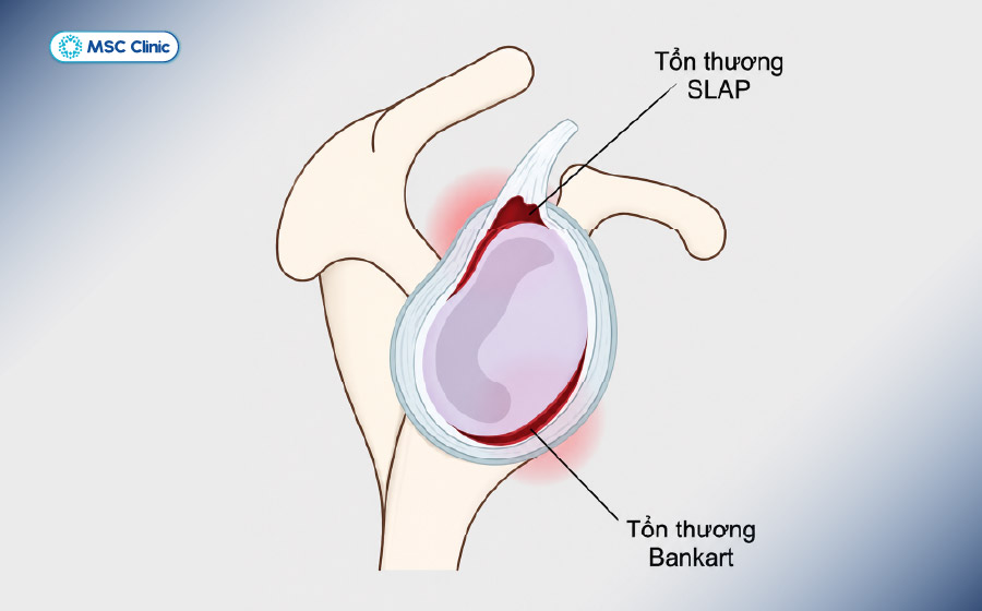 Vị trí tổn thương BankartVị trí tổn thương Bankart