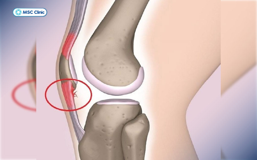Viêm gân bánh chè gây đau khớp gối khi chạy bộ