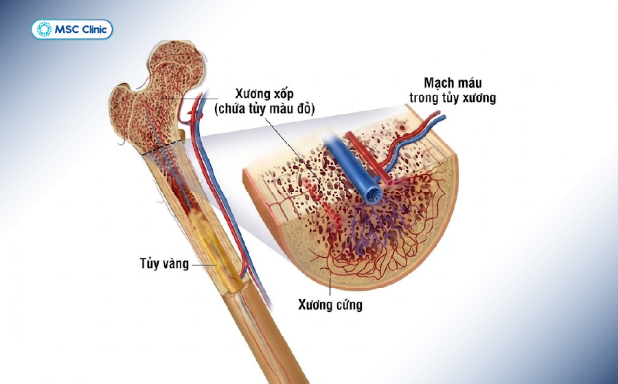 Viêm xương có thể ảnh hưởng tới xương xốp, xương đặc, tủy xương
