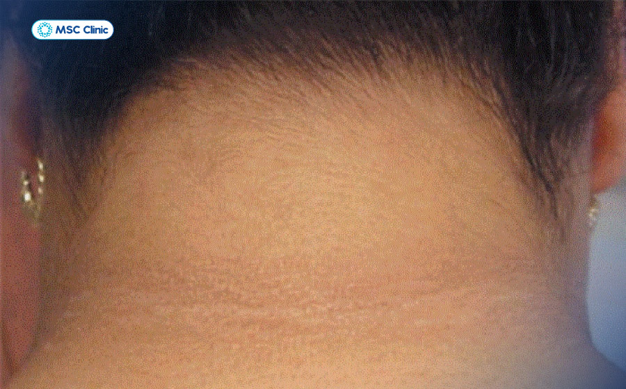 Vùng da sẫm màu, dày hơn ở cổ (gai đen) có thể là một dấu hiệu liên quan đến tình trạng kháng insulin