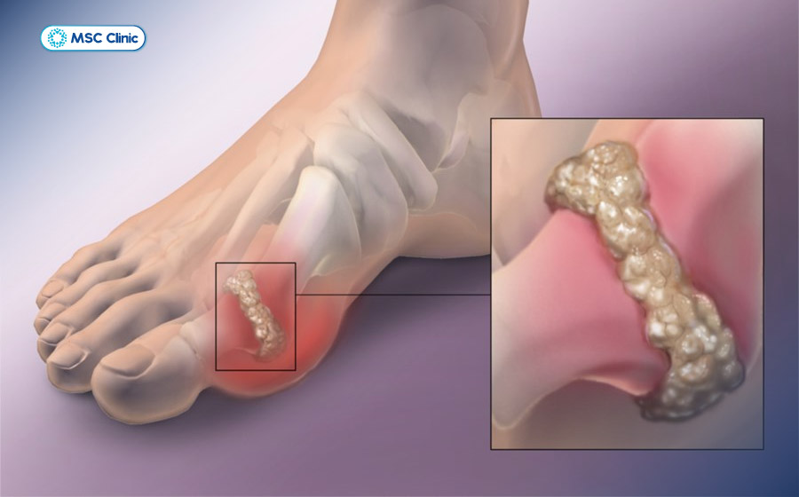 Bệnh gout gây đau đớn tại khớp và có thể ảnh hưởng đến nhiều cơ quan khác trong cơ thể