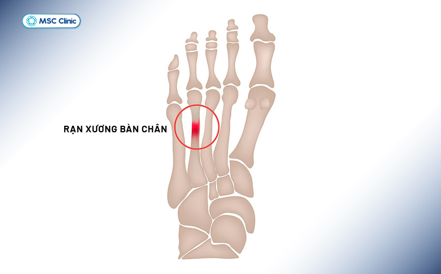 Béo phì làm tăng áp lực lên các xương chịu lực như bàn chân và có thể dẫn đến rạn xương Béo phì làm tăng áp lực lên các xương chịu lực như bàn chân và có thể dẫn đến rạn xương