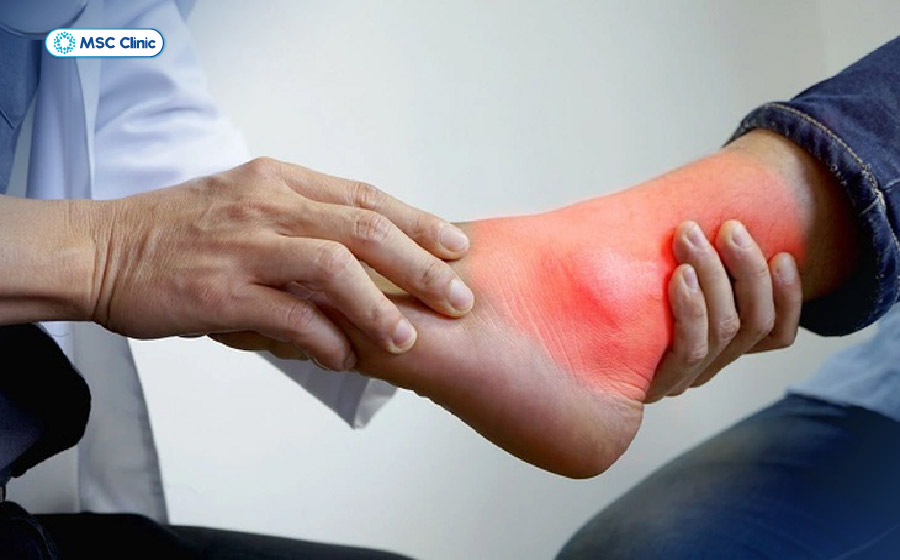 Cần đến gặp bác sĩ khi khớp sưng đỏ, đau dữ dội, hạt tophi to nhanh