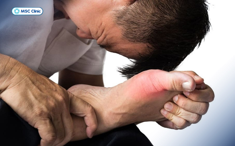 Đau nhức dữ dội tại khớp ngón chân cái là dấu hiệu bệnh gout cần đặc biệt chú ý