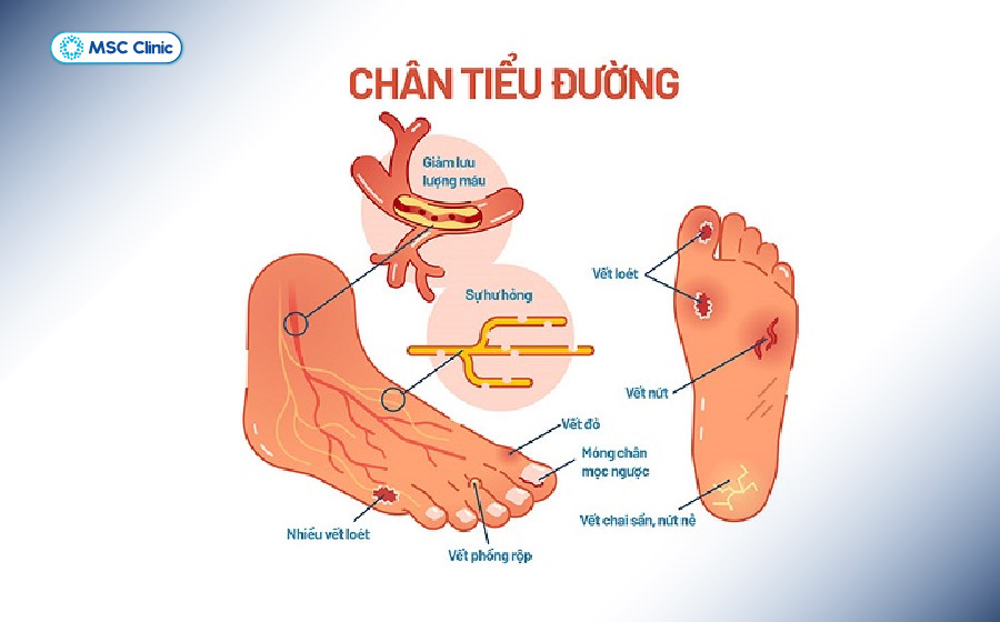 Giảm cảm giác và tuần hoàn kém làm tăng nguy cơ loét bàn chân ở người tiểu đường