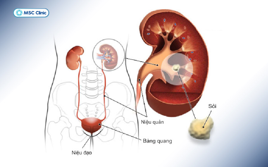 Gout gây tích tụ urat dẫn đến nhiều biến chứng nguy hiểm tại thận