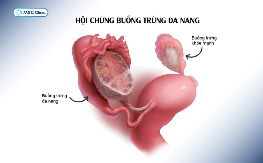 Hội chứng buồng trứng đa nang làm tăng nguy cơ mắc đái tháo đường