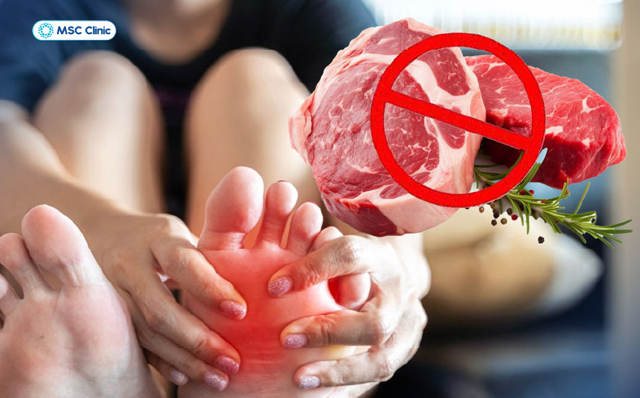 Nguyên nhân gây gout phổ biến hàng đầu là chế độ ăn giàu purin