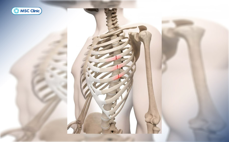 Rạn xương sườn cần được điều trị sớm để không tiến triển thành gãy xương sườn