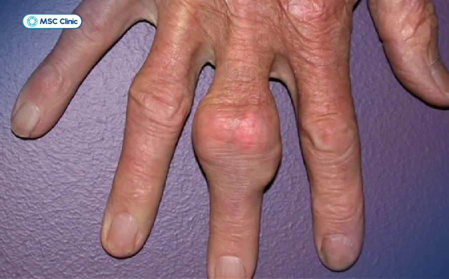 Triệu chứng bệnh gout lâu năm bao gồm hình thành hạt tophi tại nhiều vị trí trên cơ thể