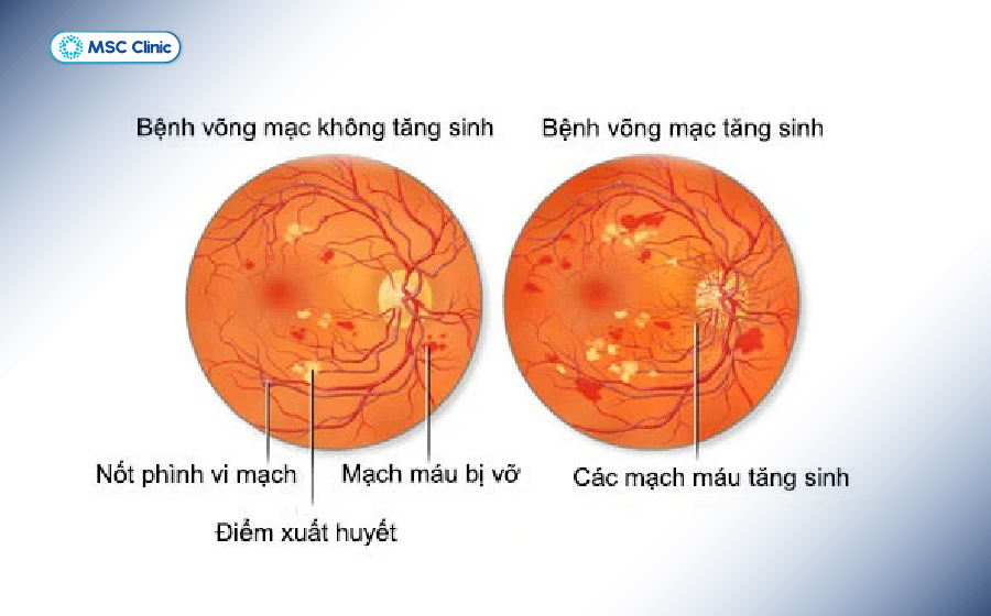 Bệnh võng mạc đái tháo đường tiến triển qua hai thể chính