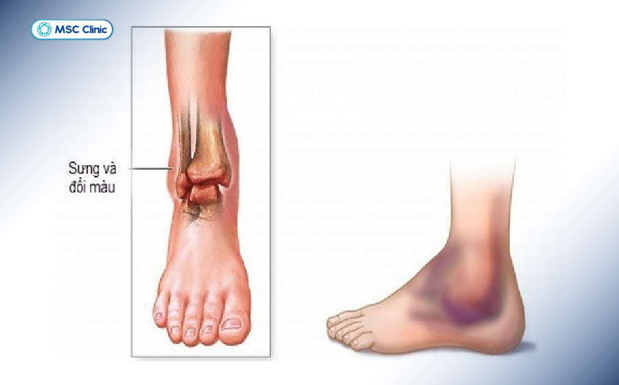 Bong gân là chấn thương phần mềm khiến cho dây chằng bị kéo căng hoặc đứt