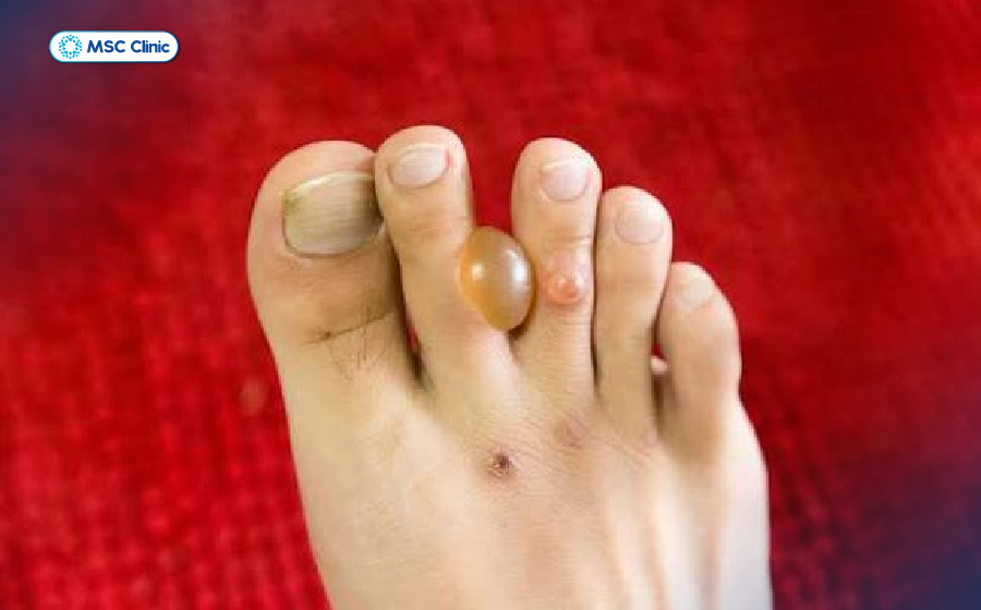 Bọng nước lớn xuất hiện tự nhiên, không do bỏng hay chấn thương ở ngón chân Bọng nước lớn xuất hiện tự nhiên, không do bỏng hay chấn thương ở ngón chân