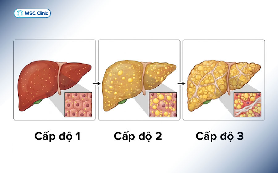 Các cấp độ gan nhiễm mỡ được chia thành 3 mức độ từ nhẹ đến nặng Các cấp độ gan nhiễm mỡ được chia thành 3 mức độ từ nhẹ đến nặng