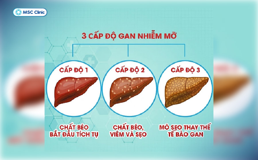 Các cấp độ gan nhiễm mỡ
