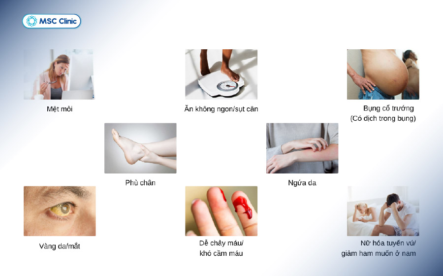 Các dấu hiệu phổ biến nhất của bệnh xơ gan