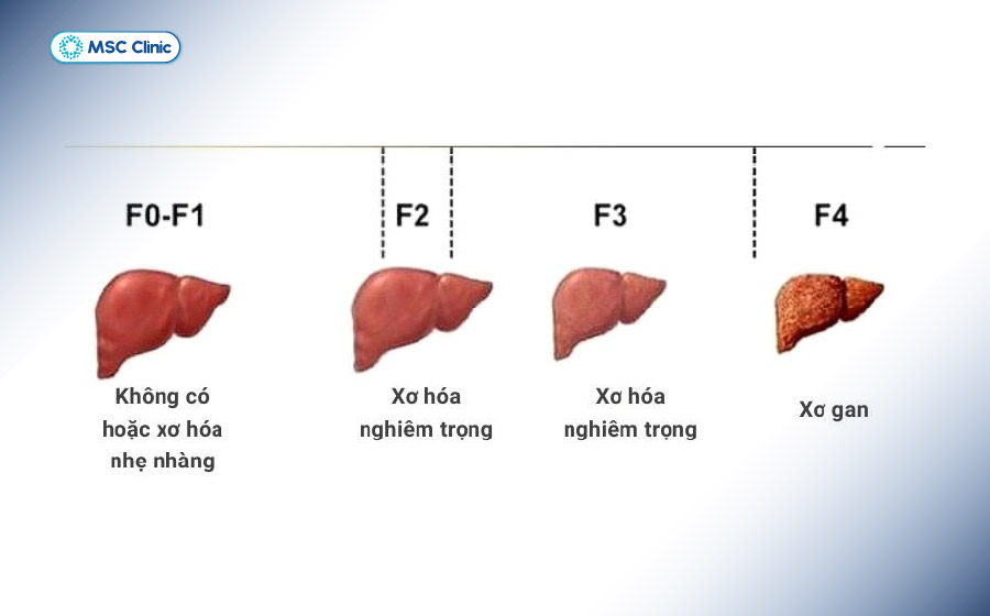 Các mức độ xơ hóa gan