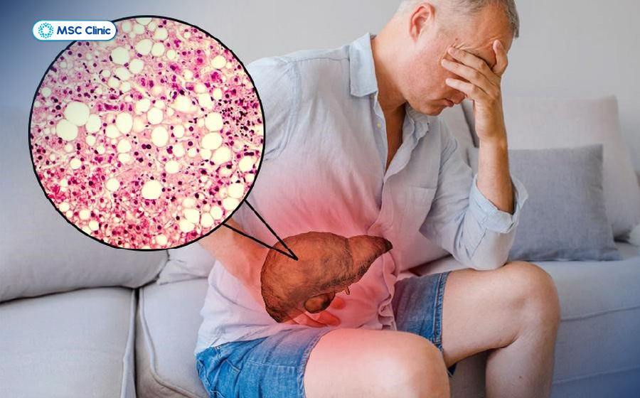 Cảm giác mệt mỏi thường xuyên khi xơ hóa gan nặng