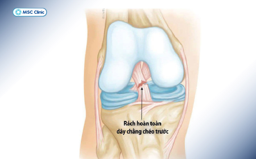 Chấn thương dây chằng ACL có thể xảy ra sau một lần va chạm mạnh