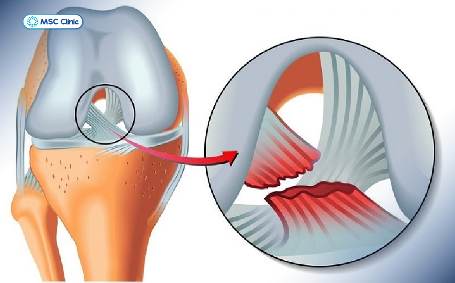 Chấn thương dây chằng chéo trước ở đầu gối