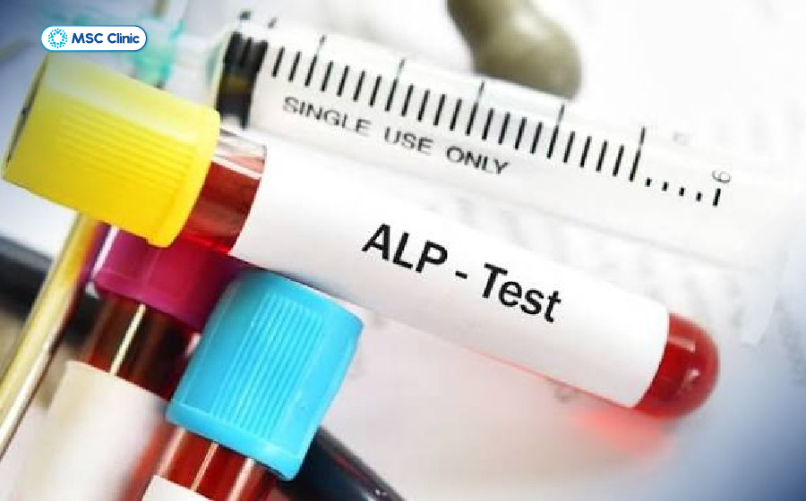 Chỉ số enzyme ALP tăng cao thường liên quan đến tình trạng tắc nghẽn đường mật hoặc bệnh về xương Chỉ số enzyme ALP tăng cao thường liên quan đến tình trạng tắc nghẽn đường mật hoặc bệnh về xương