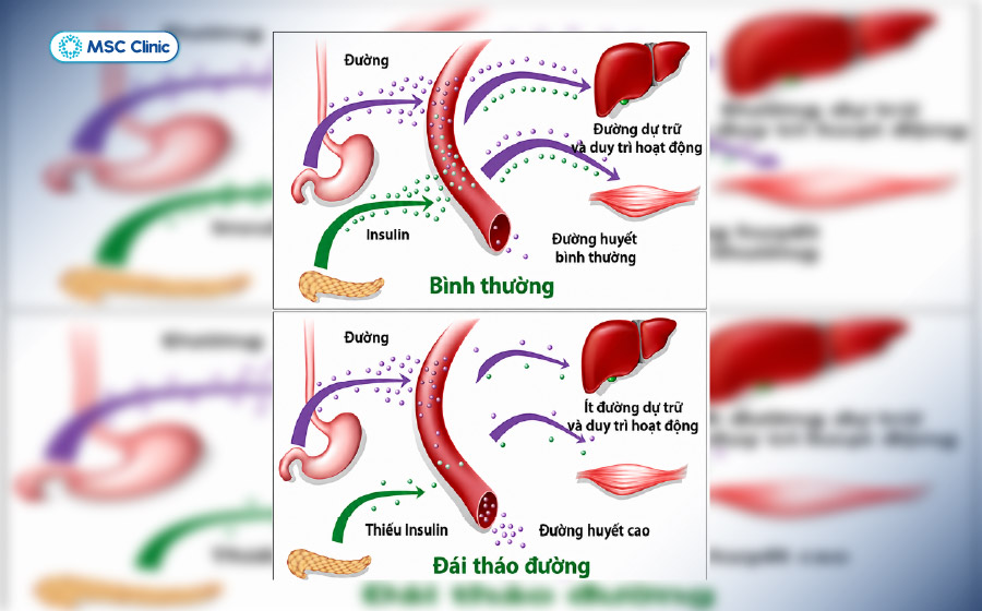 Đái tháo đường do rối loạn chuyển hóa