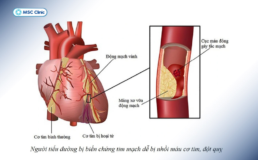 Đái tháo đường gây ra nhiều biến chứng nguy hiểm trong đó có bệnh tim mạch
