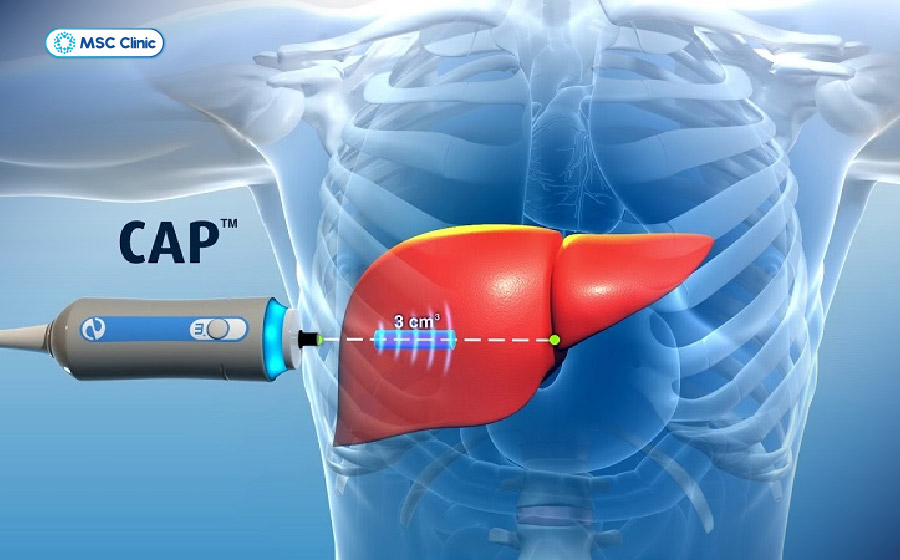 Đo độ đàn hồi giúp đánh giá nguy cơ xơ hóa bên cạnh mức độ gan nhiễm mỡ cấp độ 1