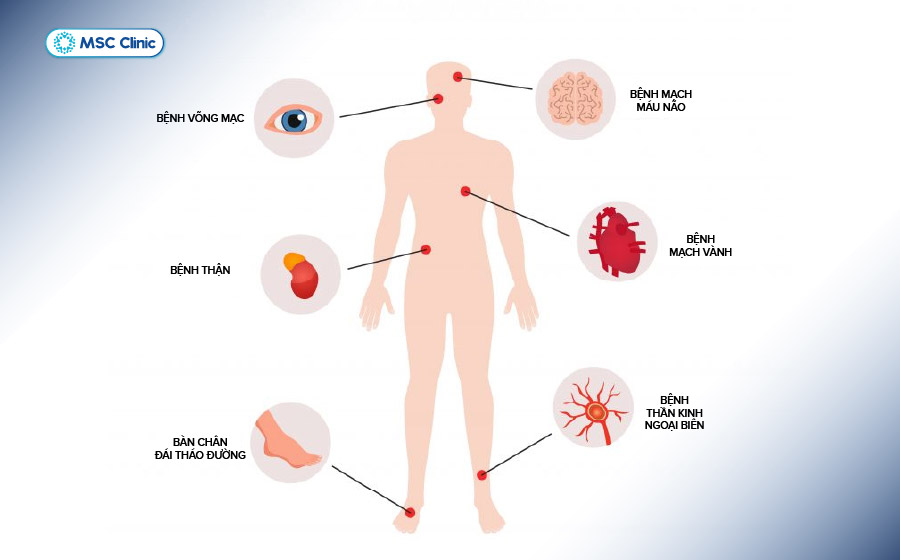 Đường huyết cao kéo dài có thể dẫn tới nhiều biến chứng tiểu đường nghiêm trọng