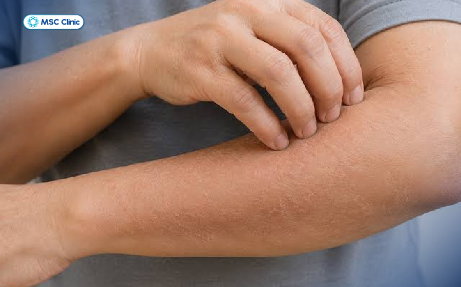 Đường huyết cao làm tổn thương mạch máu nhỏ, khiến da thiếu oxy và dưỡng chất nên dễ bị khô ráp, ngứa ngáy Đường huyết cao làm tổn thương mạch máu nhỏ, khiến da thiếu oxy và dưỡng chất nên dễ bị khô ráp, ngứa ngáy